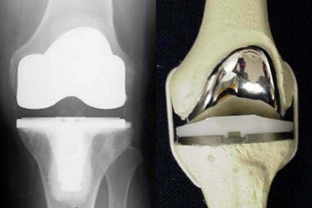 Knee replacement for osteoarthritis