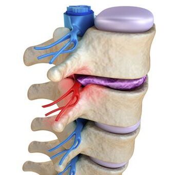 A pinched nerve in the spine is accompanied by severe pain