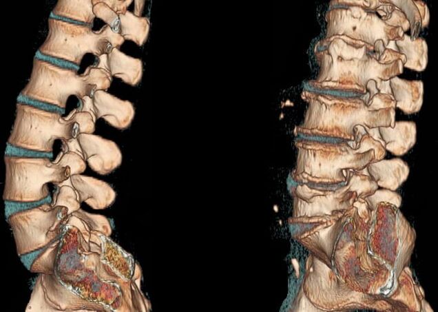 Osteochondrosis of the lumbar region