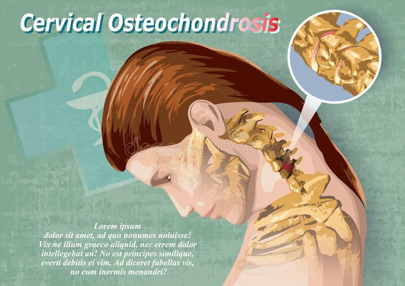 Cervical osteochondrosis is a disease of cartilage tissue
