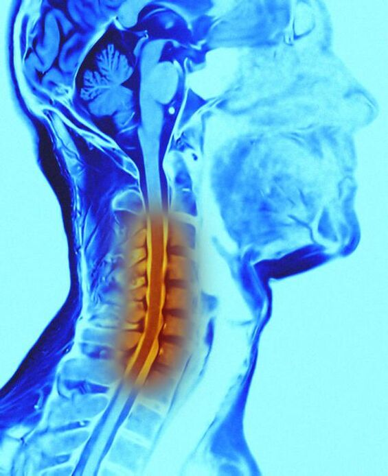 cervical spine and osteochondrosis